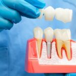 all on 4 dental implants cost