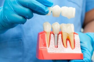 all on 4 dental implants cost