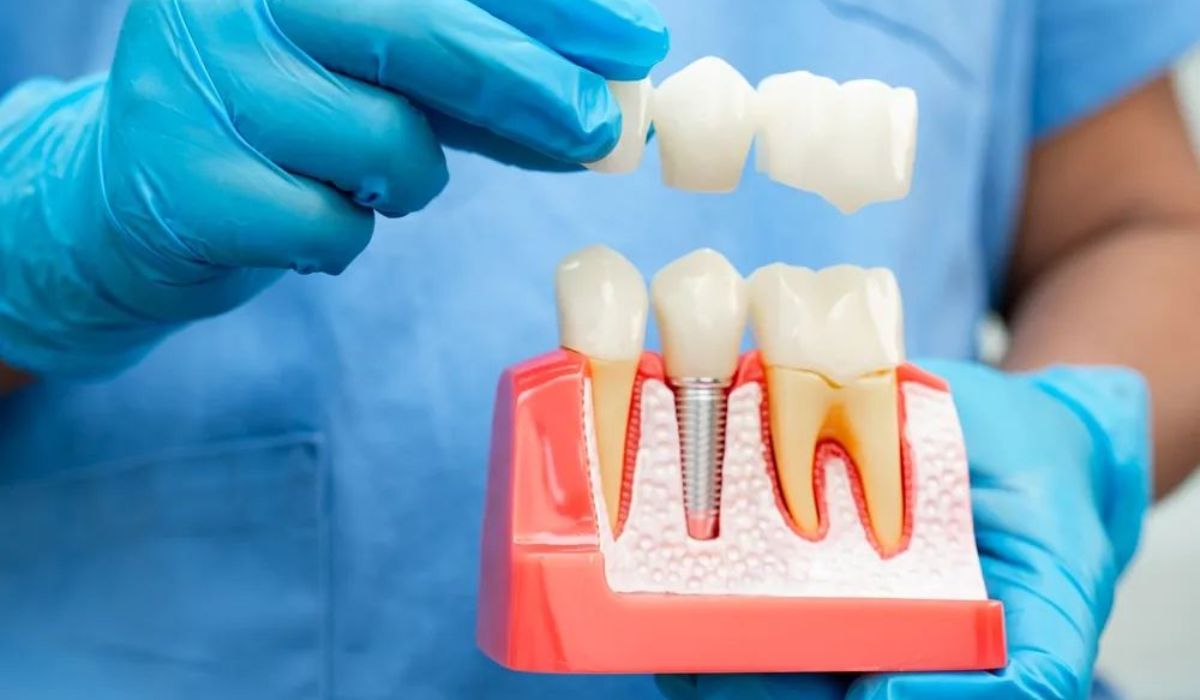 all on 4 dental implants cost